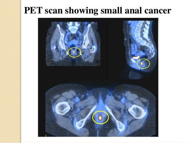 pet scan for anal cancer Love to swallow cum